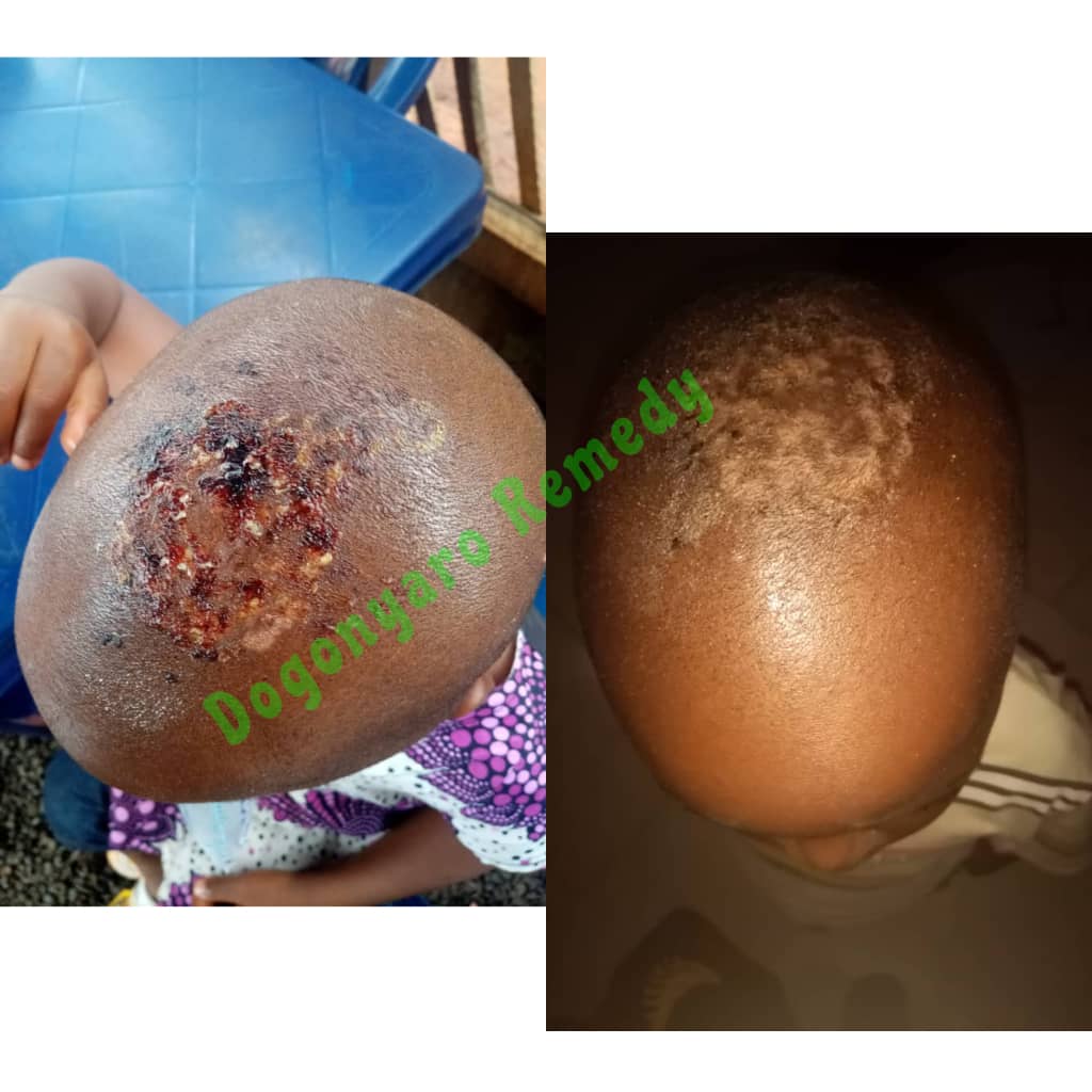 Ringworm patch cleared